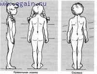Сколиоз у ребенка. Как с ним бороться Сколиоз у ребенка. Как с ним бороться