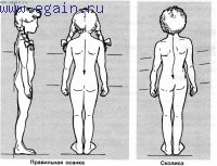 Сколиоз у ребенка. Как с ним бороться